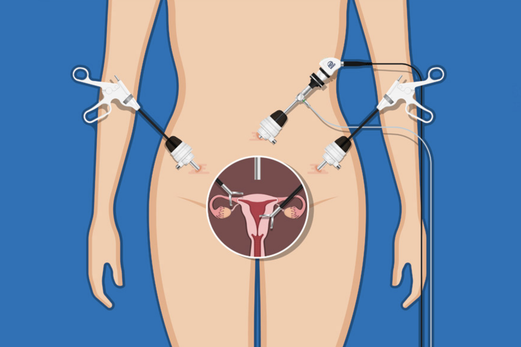 Endometriosis Todo Lo Que Necesita Saber Equipo Médico Nuevo Usado Y Reacondicionado 6118